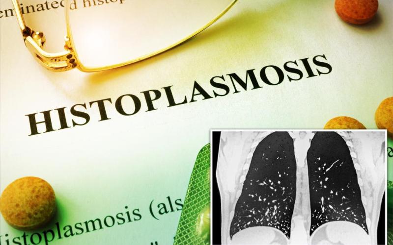 Potentially deadly fungus leaves dozens sickened as infection spreads...